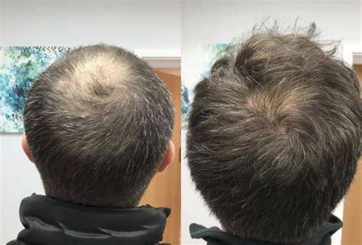 Fans Wonder If Udonis Haslem Has Had Head Injury or Is It Hair Loss Resulting In Bald Spots