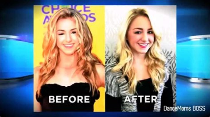 What Happened To Chloe Lukasiak? Eye Condition And Whereabouts Now