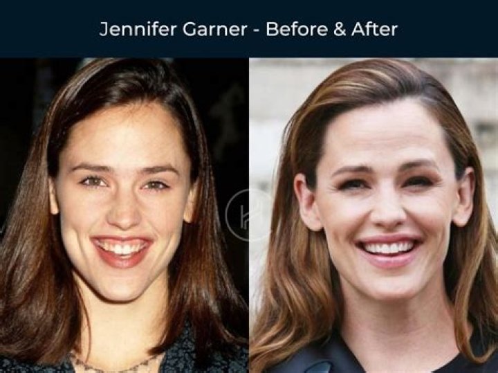 What’s Wrong With Gabi Butler Teeth? Before And After Fixing – Cheer