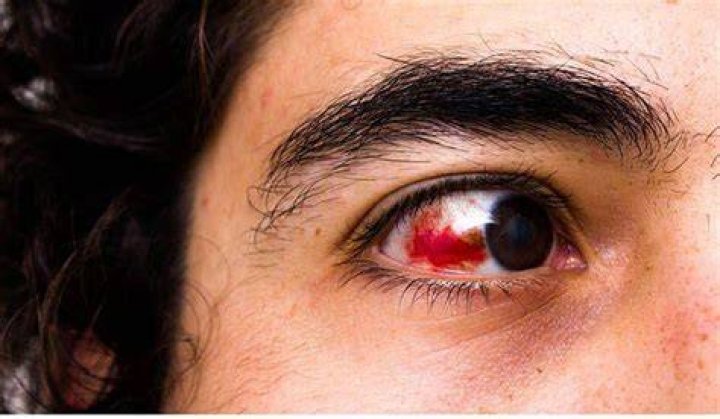 Why Are Troy Aikmans Eyes Ao Red? Fans Are concerned About The Bloodshot Eyes